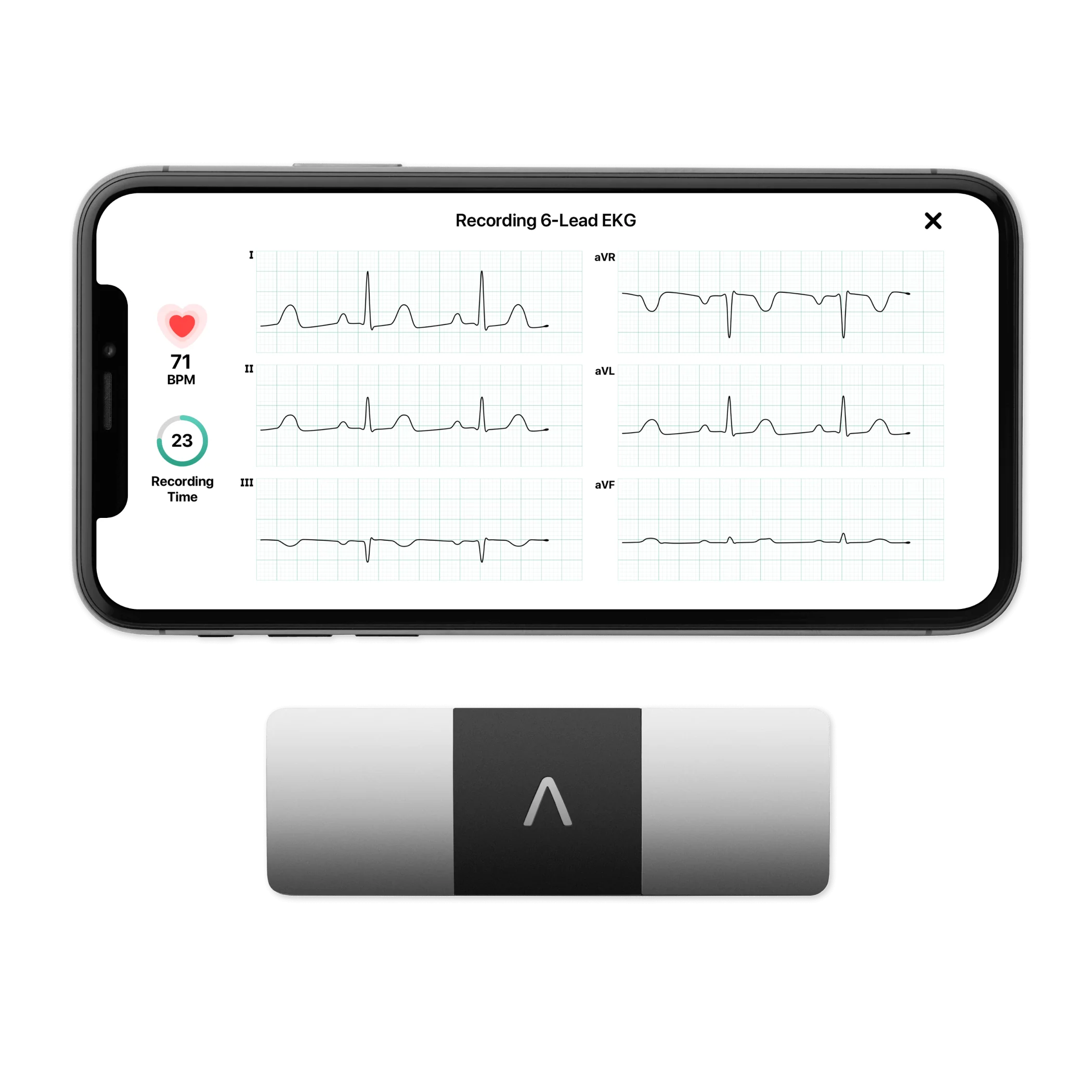 ECG